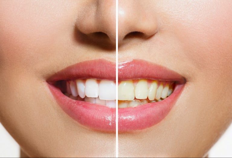 Zoom teeth whitening omaha ne