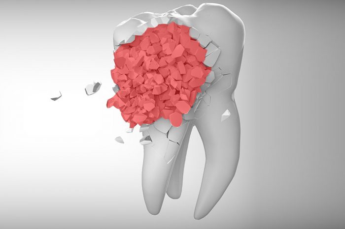 What Are the Symptoms of Tooth Infection? | Regency Dental | Omaha, NE